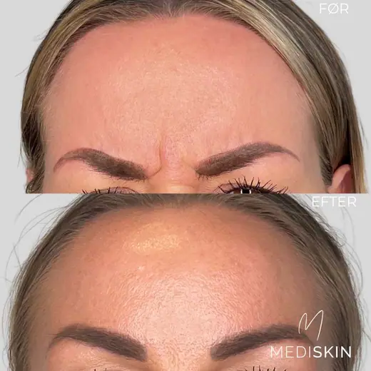 Før og efter botox mellem brynene: de dybe rynker mellem brynene er næsten væk, når hun rynker panden