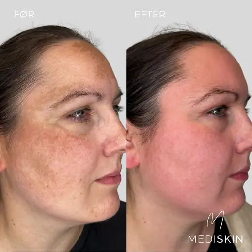 Før og efter Cosmelan peeling mod melasma, set fra siden: de brune pigmentområder på kinden er markant lysere