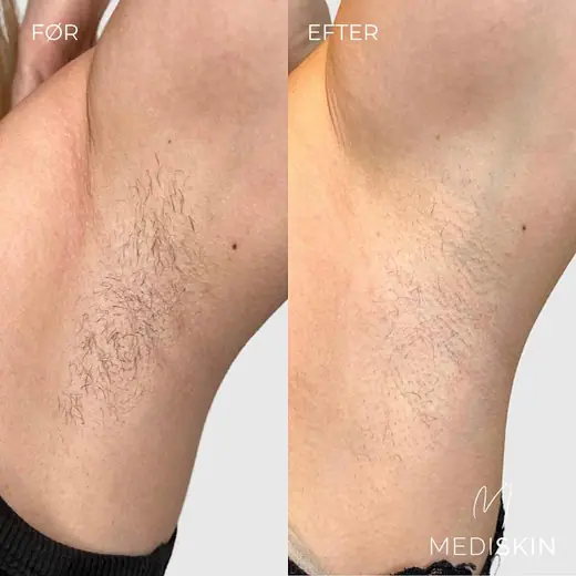 Før og efter permanent hårfjerning i armhulen: håret er væk efter forløbet