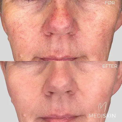 Før og efter IPL/laserbehandling af karsprængninger omkring næse og kinder: rødmen er tydeligt mindre