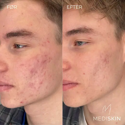 Før og efter microneedling i ansigtet, set skråt fra siden: de røde mærker efter akne på kinden er mindre tydelige