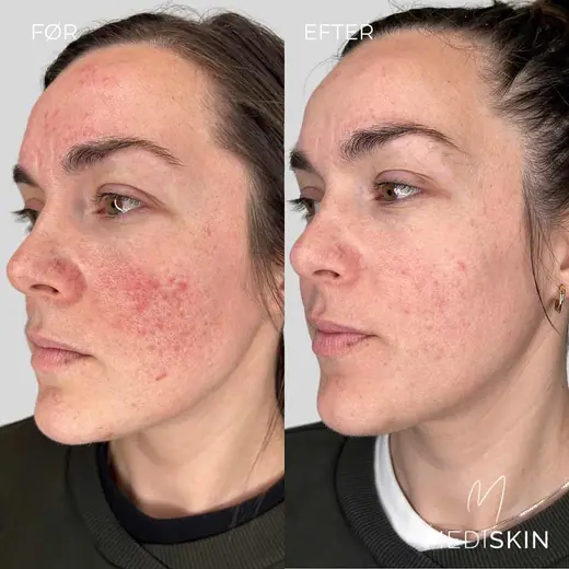Før og efter IPL/laserbehandling af rosacea: rødmen og de røde knopper på kinden er tydeligt mindre