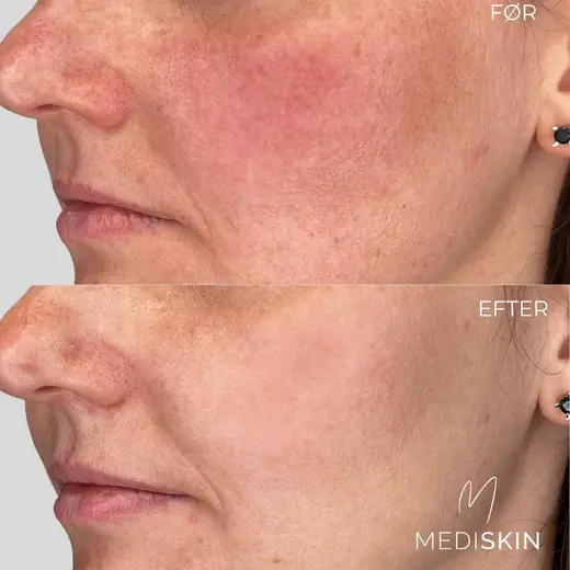 Før og efter IPL/laserbehandling af diffus rødme på kinden: rødmen er mindre