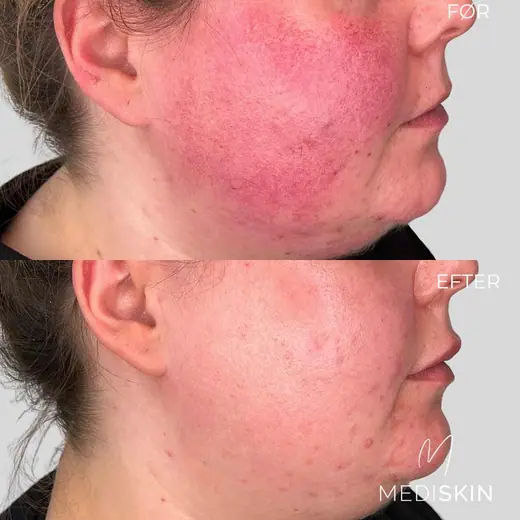 Før og efter IPL/laserbehandling af rosacea: den kraftige rødme på kind og kæbe er markant mindre