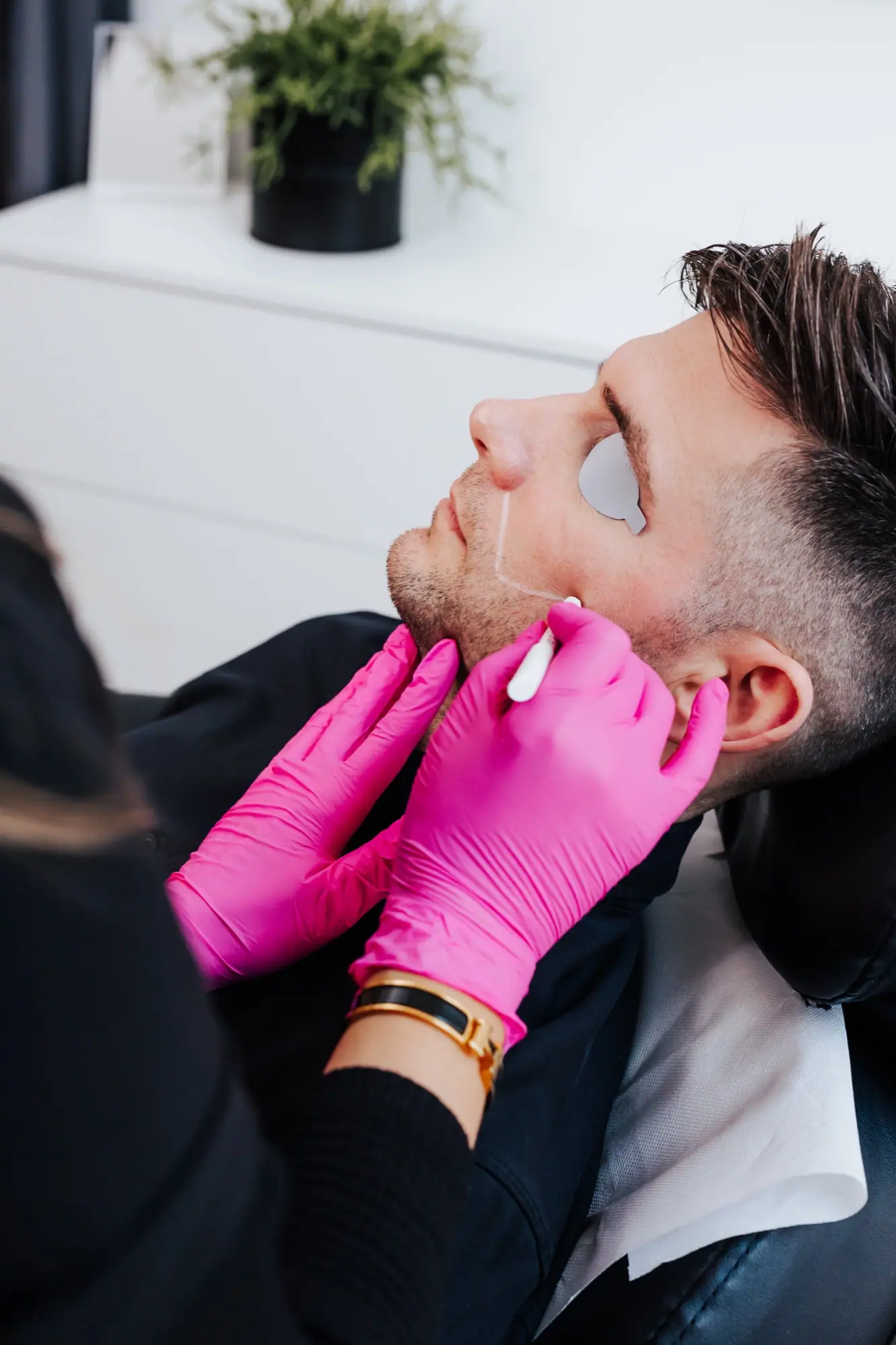 Skægkanten tegnes op med hvid blyant før laserhårfjerning hos MediSkin i Kolding
