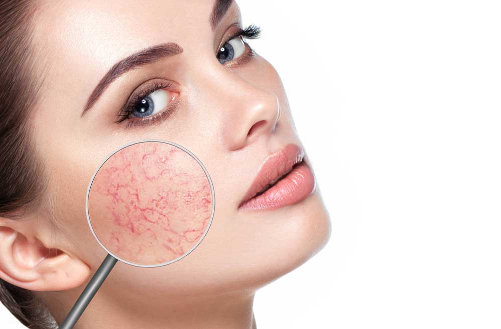 karudvidelser rosacea IPL Laser