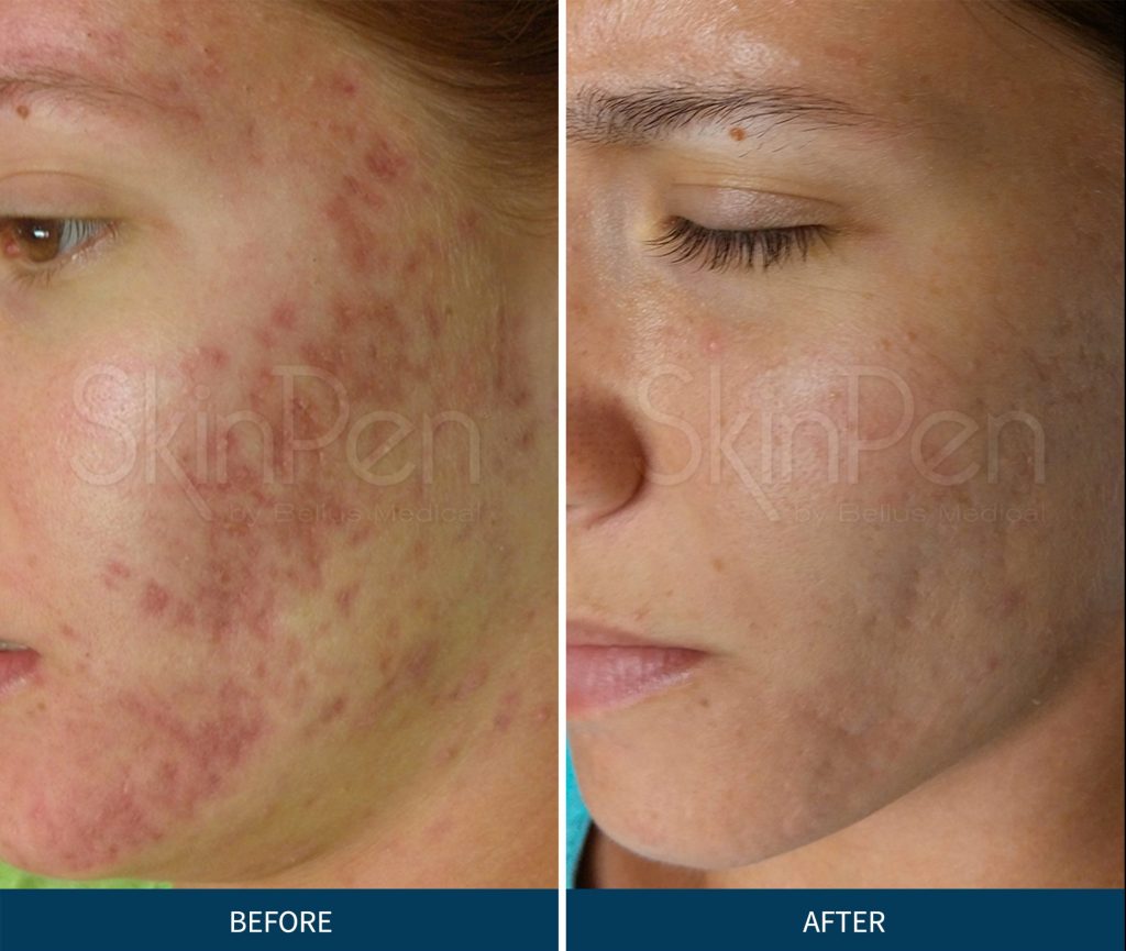 SkinPen før og efter billede