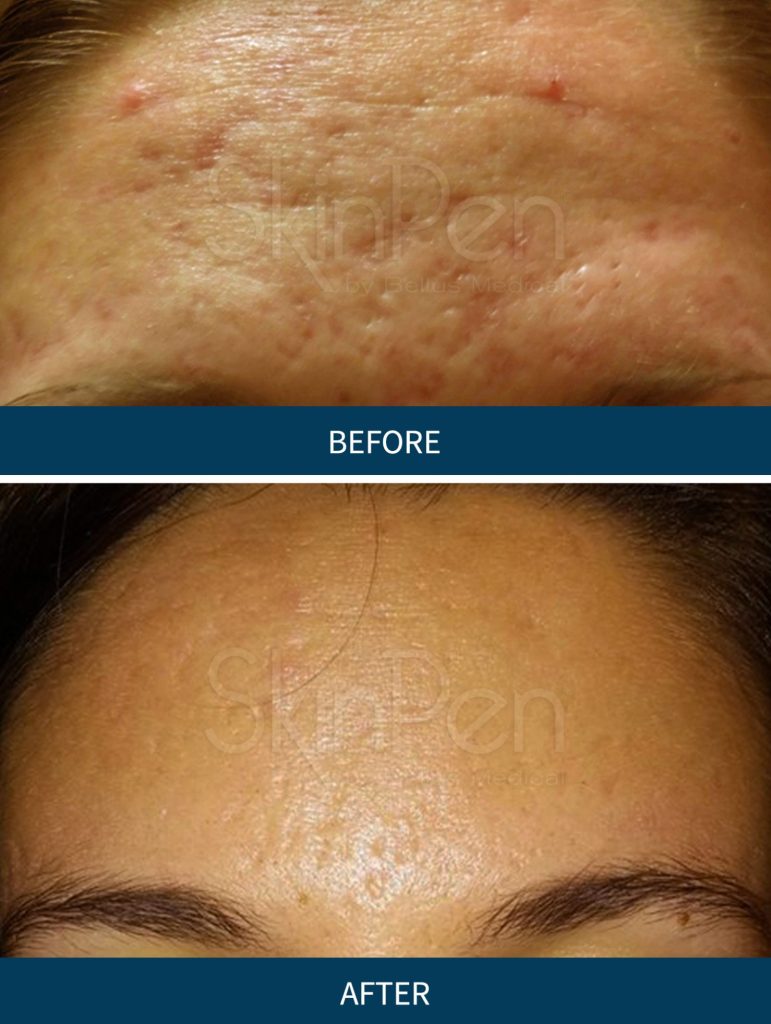 SkinPen før og efter billede