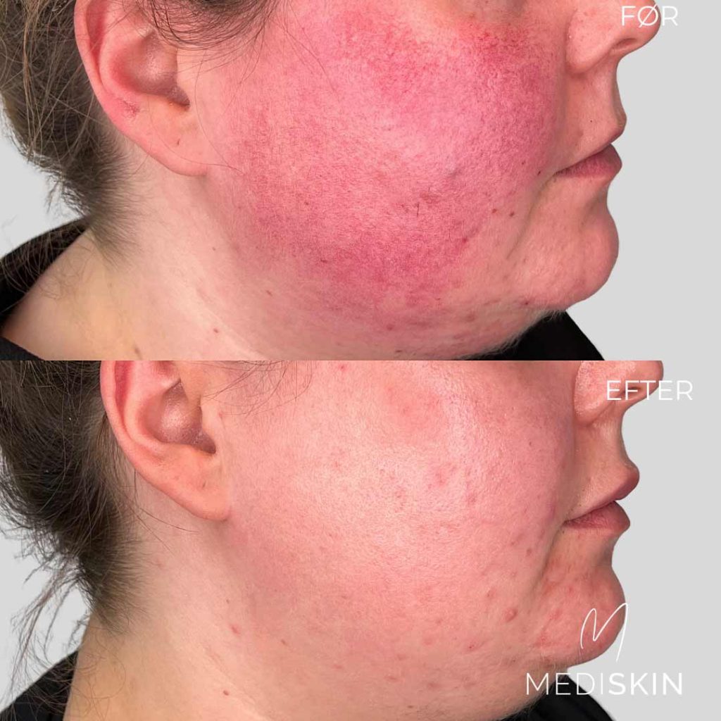 Behandling af rosacea